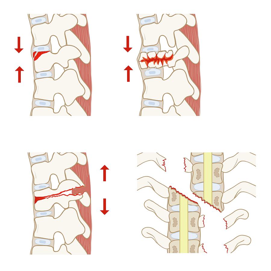 Types Of Spinal Fracture Photograph by Jeanette Engqvist | Fine Art America