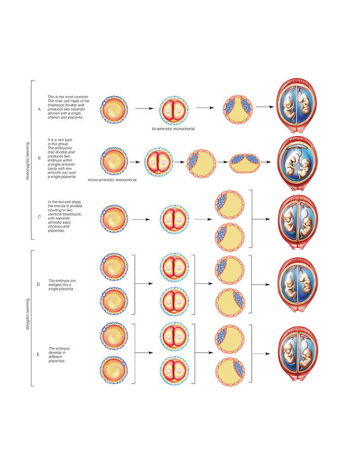 Types Of Twin Photograph by Asklepios Medical Atlas