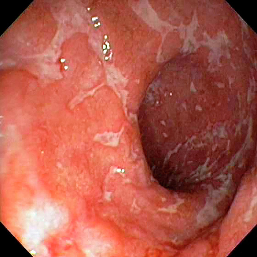 Ulcerative Colitis In The Rectum Photograph by Gastrolab/science Photo Library