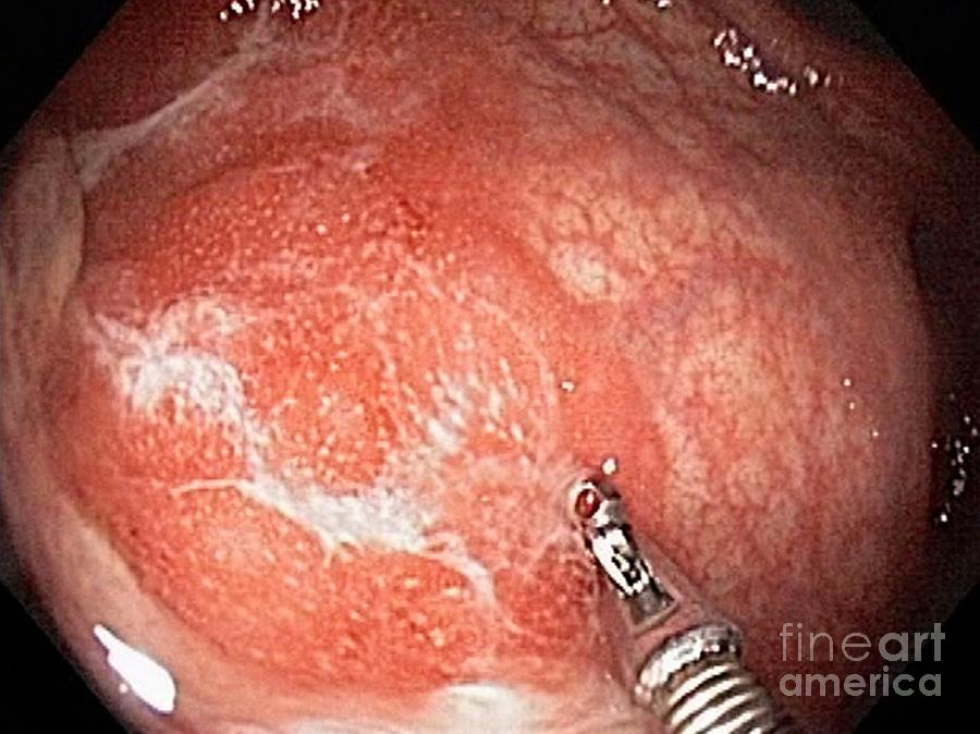 Digestive System Photograph - Ulcerative Proctitis, Endoscopic View by Gastrolab