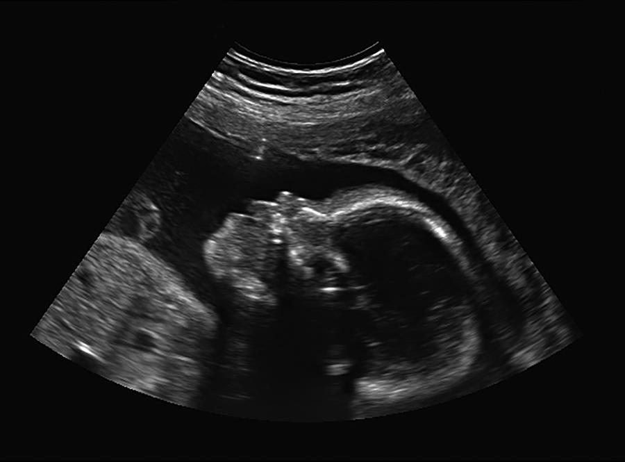 Ultrasound Of Baby In Pregnant Woman Photograph by Sunyaluk