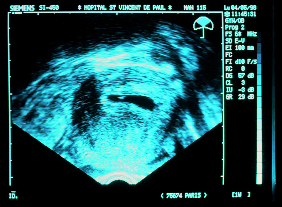 Ultrasound Scan Of An Ivf Embryo In The Uterus Photograph by Pascal