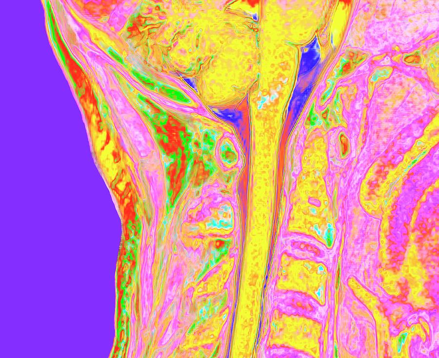 Upper Spinal Cord And Vertebrae Photograph by K H Fung/science Photo Library