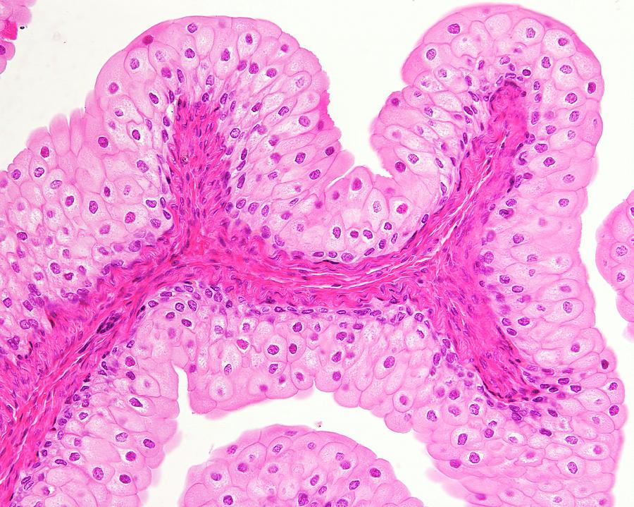 pink tissue fragments in urine