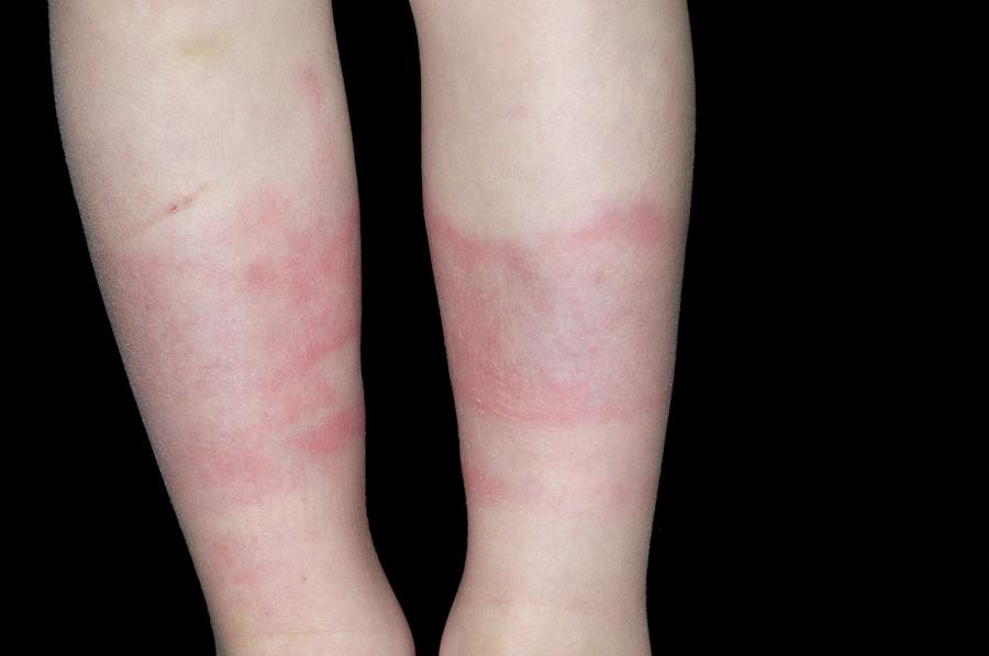 Urticaria Caused By The Cold Photograph by Dr P. Marazzi/science Photo ...