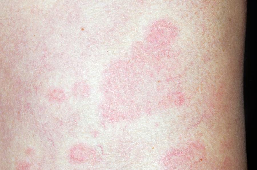 Urticaria Hives On The Body Photograph By Dr P Marazziscience Photo Library 