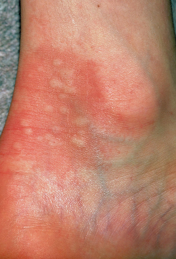 hiv-rash-on-feet