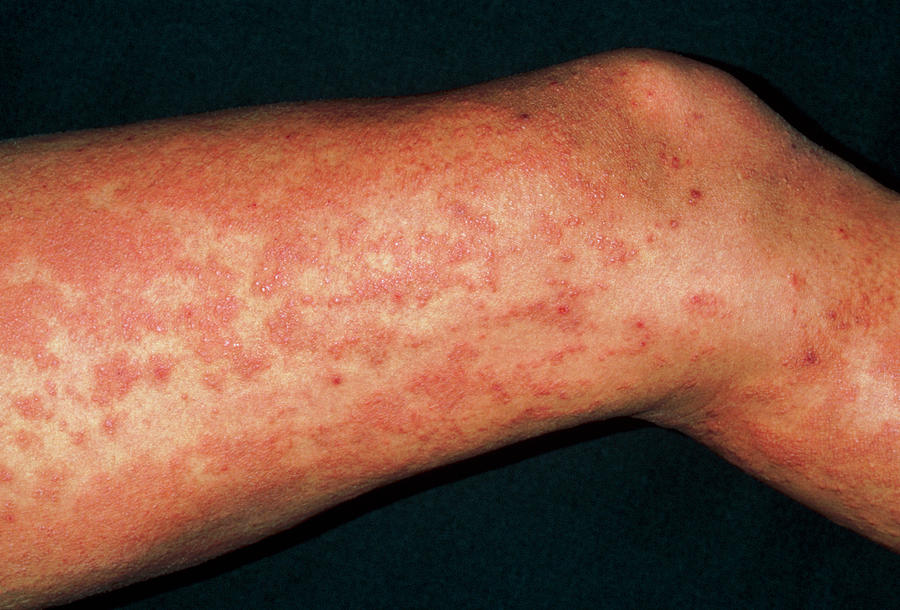 Urticaria Rash hives On Legs Due To Exam Stress Photograph By Dr P 