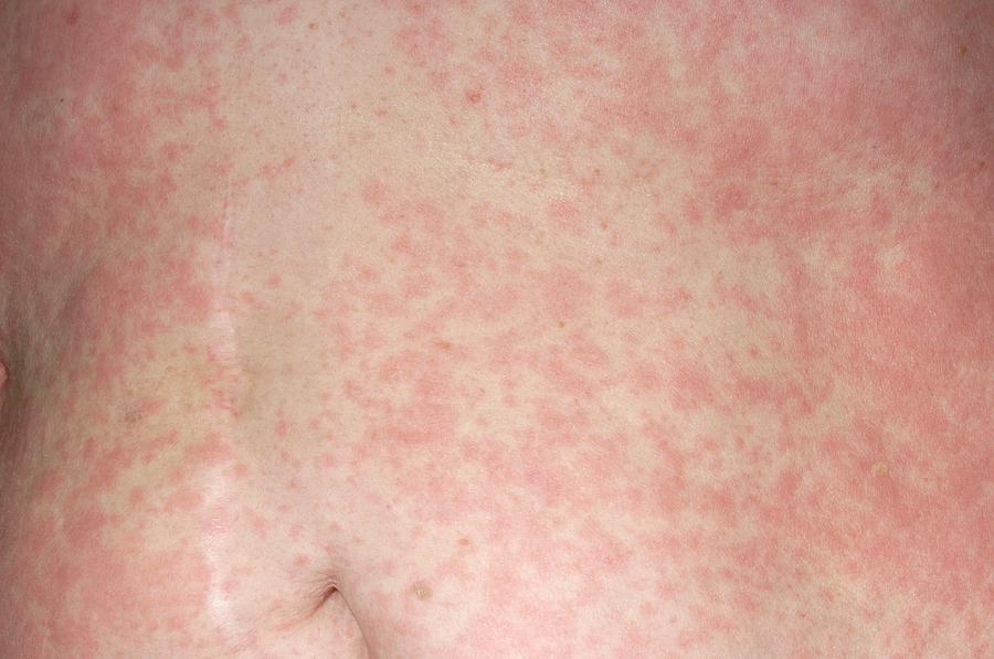 urticaria-rash-on-abdomen-photograph-by-dr-p-marazzi-science-photo-library