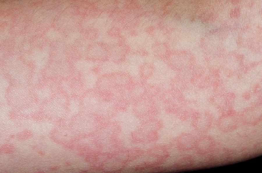 Urticaria Reaction To Viral Infection Photograph by Dr P. Marazzi