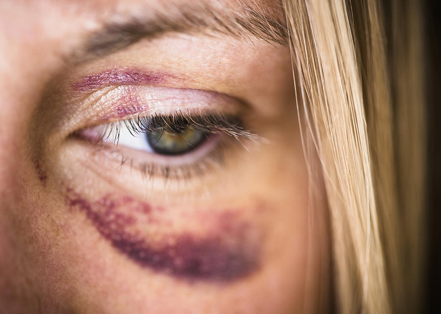 USA, New Jersey, Jersey City, Portrait of woman with black eye Photograph by Tetra Images - Jamie Grill