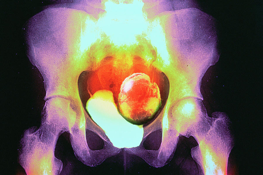 Uterine Fibroid Photograph by Gjlp/cnri/science Photo Library