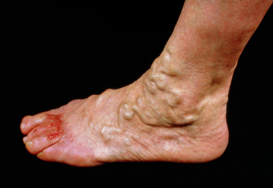 varicose-veins-on-the-foot-with-ulceration-of-toes-photograph-by