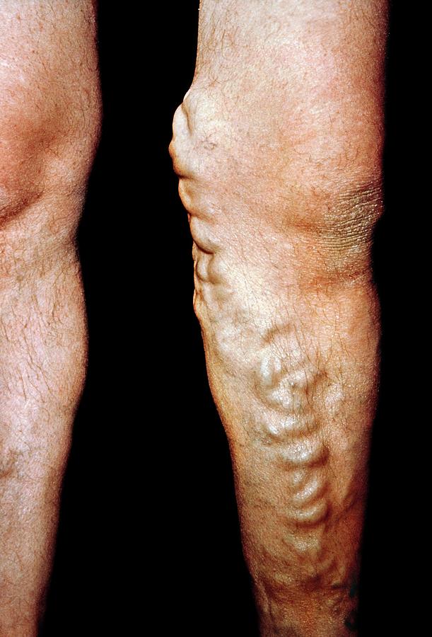 Varicose Veins Photograph by Science Photo Library Varicose Veins Photograph by Science Photo Library