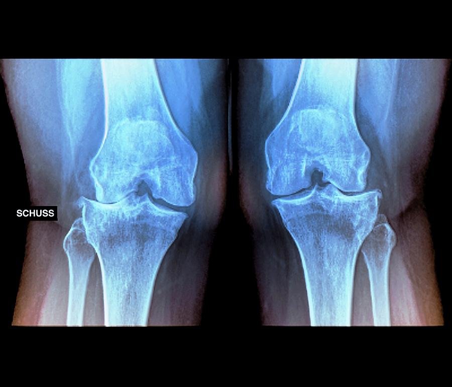 Varus Deformity In Osteoarthritis Photograph by Science Photo Library ...