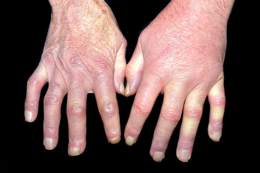 Vasculitis In Scleroderma And Mrsa Photograph By Dr P Marazziscience