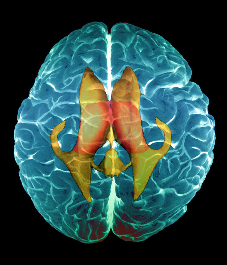 Ventricles Of Brain Photograph by Zephyr/science Photo Library