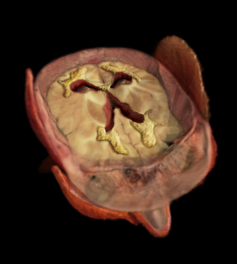 Ventricular Dilation, Male Brain Photograph by Anatomical Travelogue