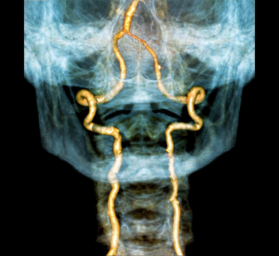 vertebral-artery-insufficiency-photograph-by-zephyr-pixels