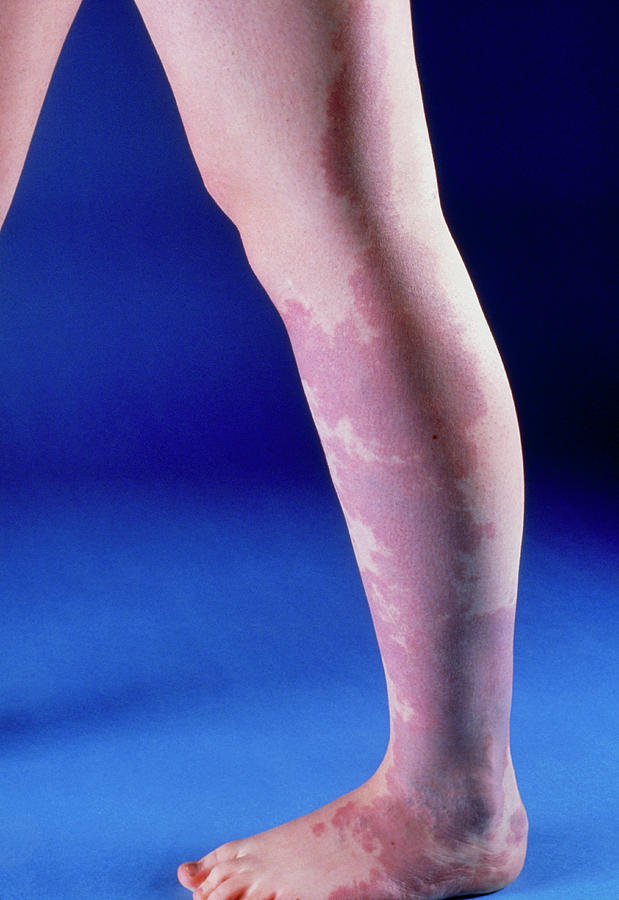 View Of A Port-wine Stain On The Leg Of A Child Photograph by Mike Devlin/science Photo Library