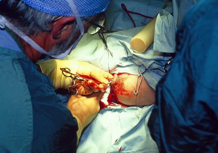 View Of A Surgeon Operating On Anal Polyps Photograph by Science Photo Library View Of A Surgeon Operating On Anal Polyps Photograph by Science Photo Library