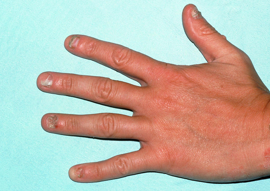 View Of Hand With Fungal Nail Infection (tinea) Photograph by Science ...