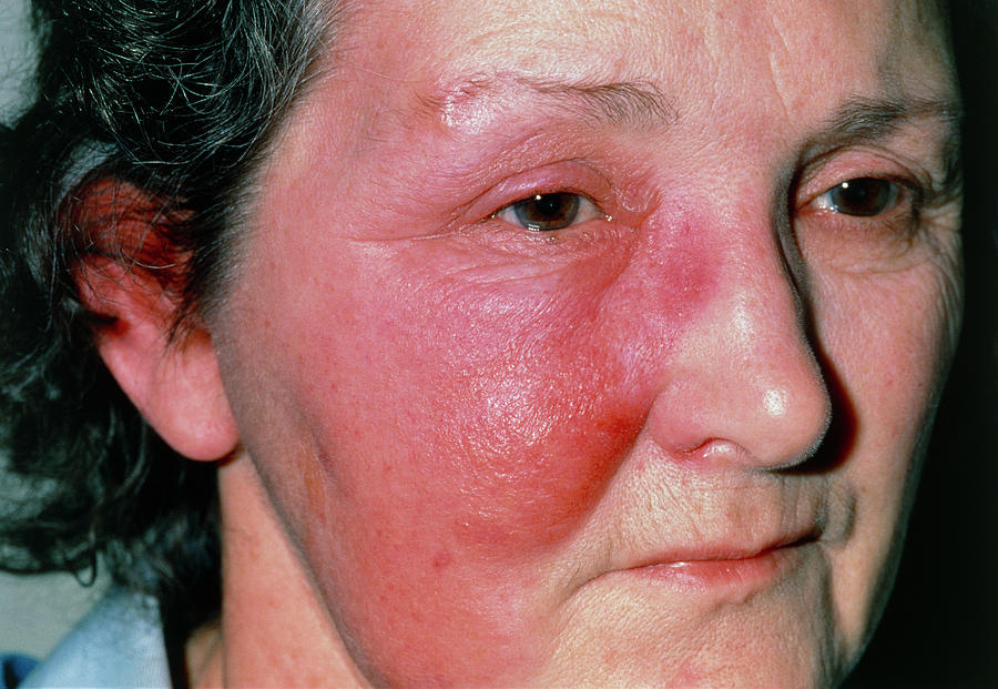 View Of Reddening Due To Erysipelas On Womans Face Photograph By Dr P