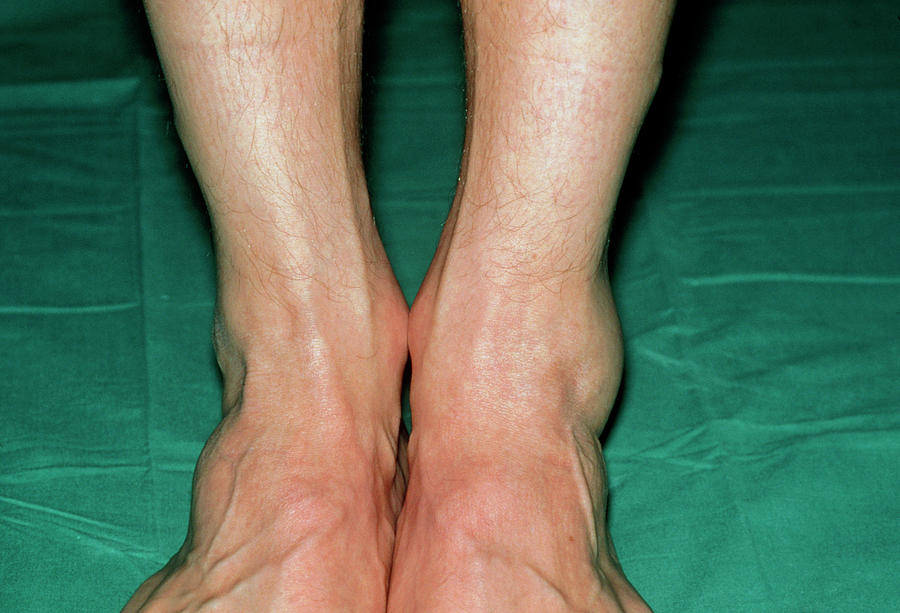 View Of Swollen Left Ankle Due To Sprain Photograph by Dr P. Marazzi ...