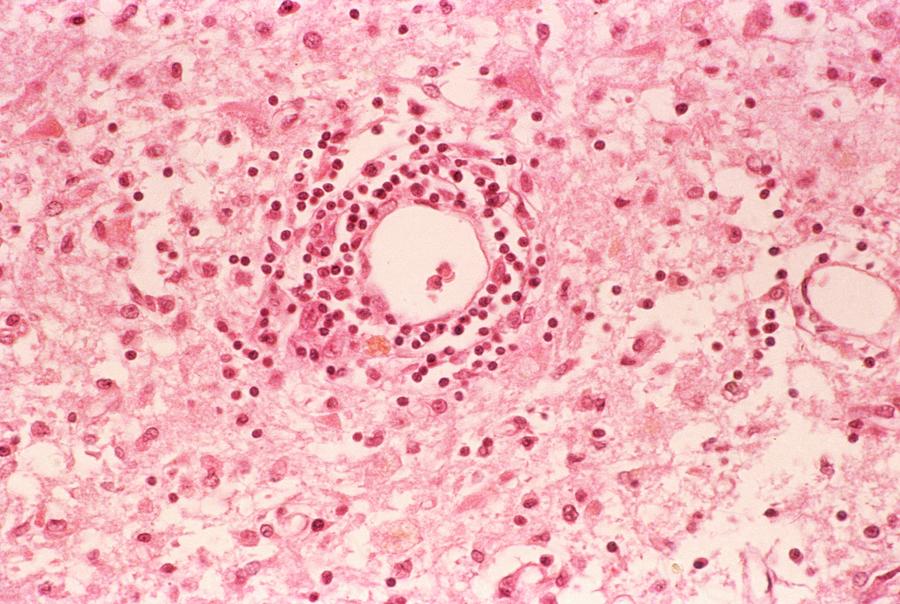 Viral Encephalitis Photograph by Pr. R. Abelanet - Cnri/science Photo Library