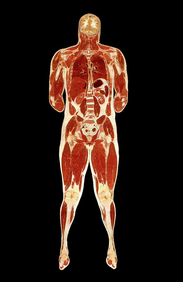 Visible Human Project: Sectioned Male Body (front) Photograph by Mehau