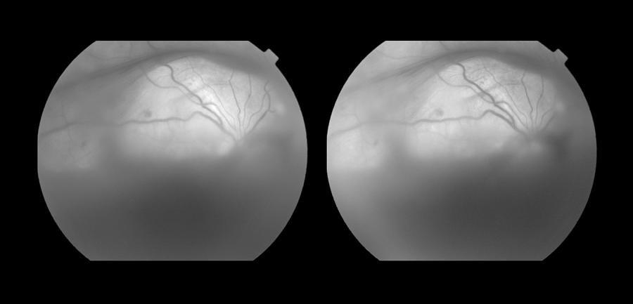Vitreous Hemorrhage Stereo Image Photograph by Paul Whitten