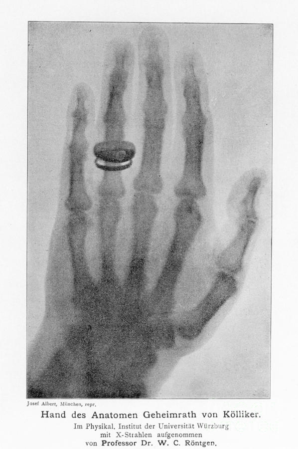W. Roentgen: X-ray (1896) Photograph by Granger