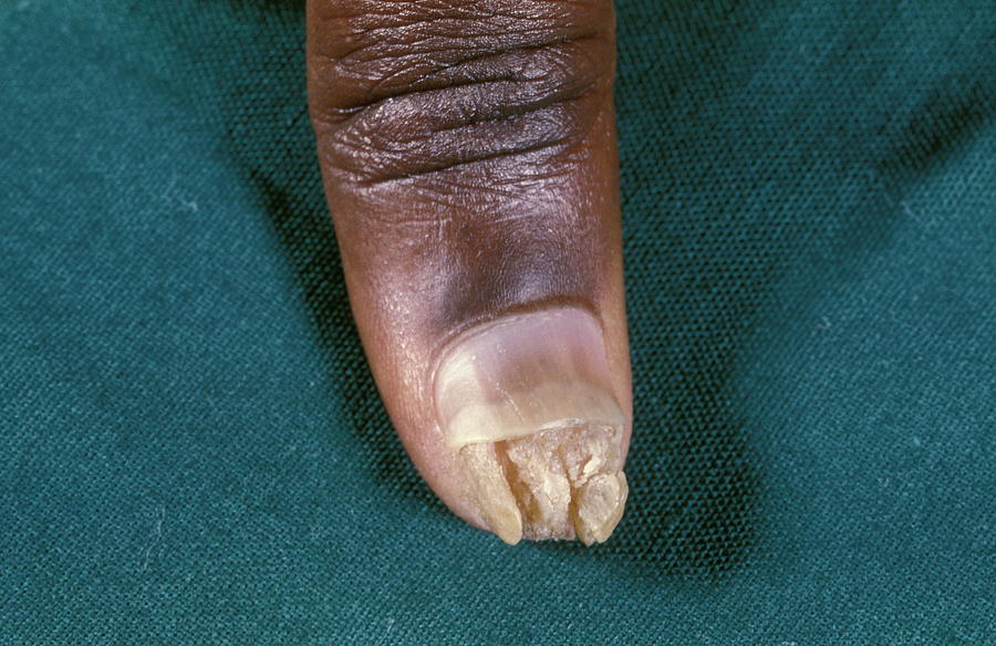 Wart Photograph by Dr M.a. Ansary/science Photo Library - Pixels