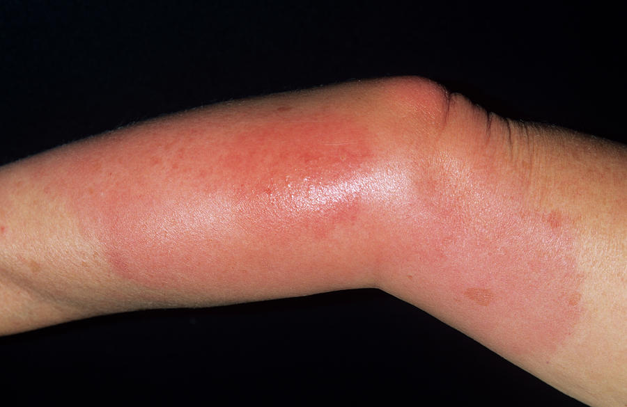 Wasp Sting Photograph By Dr P Marazzi science Photo Library