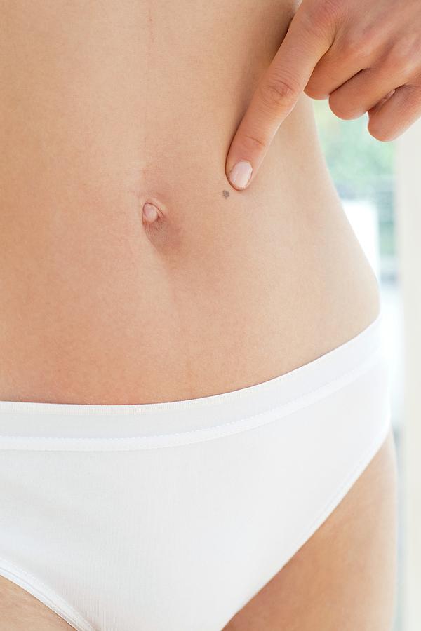 Woman Pointing To Mole On Abdomen Photograph by Ian Hooton/science Photo Library
