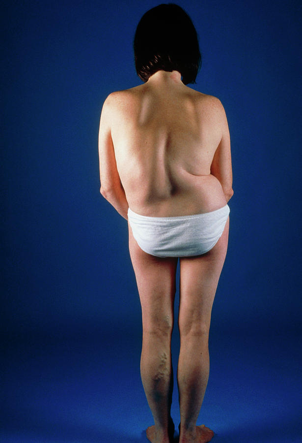 Woman With Scoliosis (curvature) Of The Spine Photograph by Medical Photo Nhs Lothian/science Photo Library
