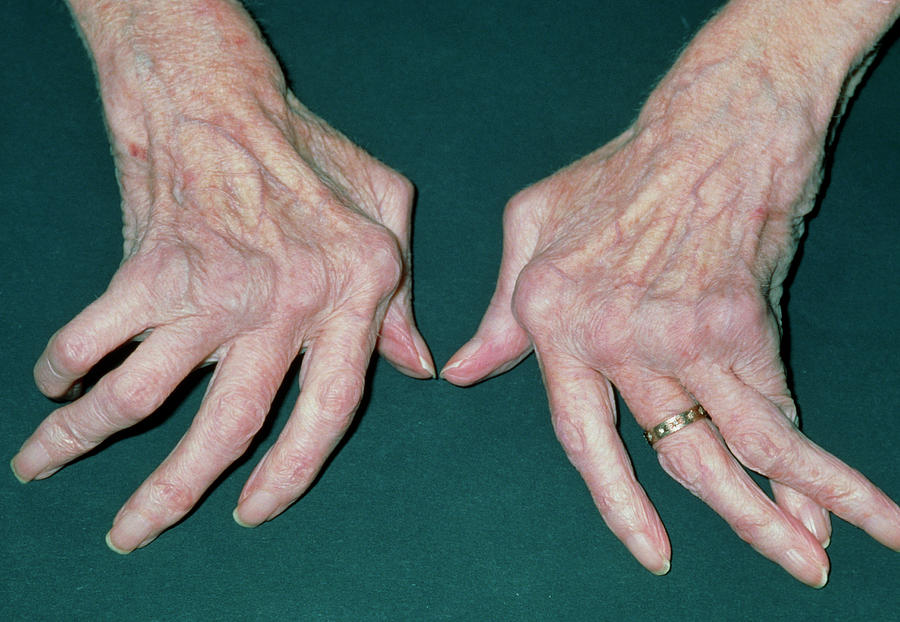 Woman's Hands Crippled With Rheumatoid Arthritis Photograph by Dr P