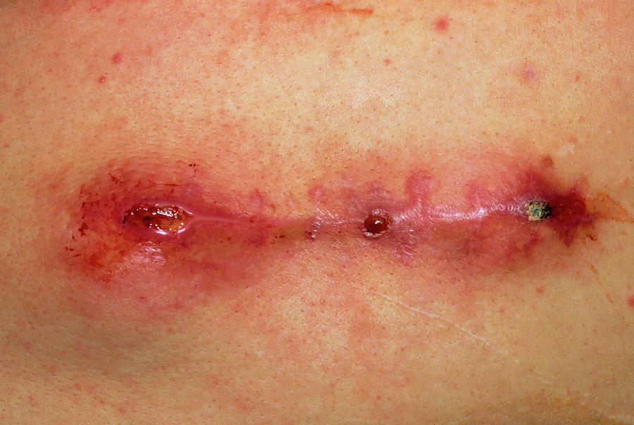 abdominal wound infection
