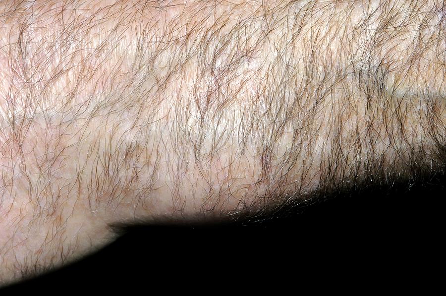 Wrist Swelling Due To Arthritis Photograph by Dr P. Marazzi/science