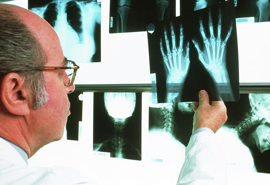 X Ray Diagnosis Of Rheumatoid Arthritis Photograph By Mauro Fermariello Science Photo Library