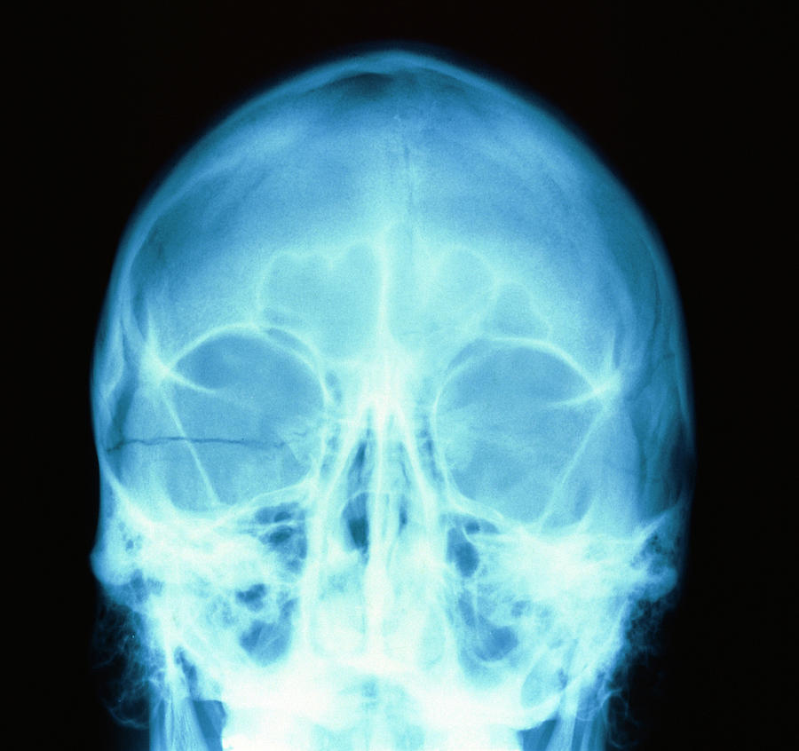 Fractured Skull X Ray