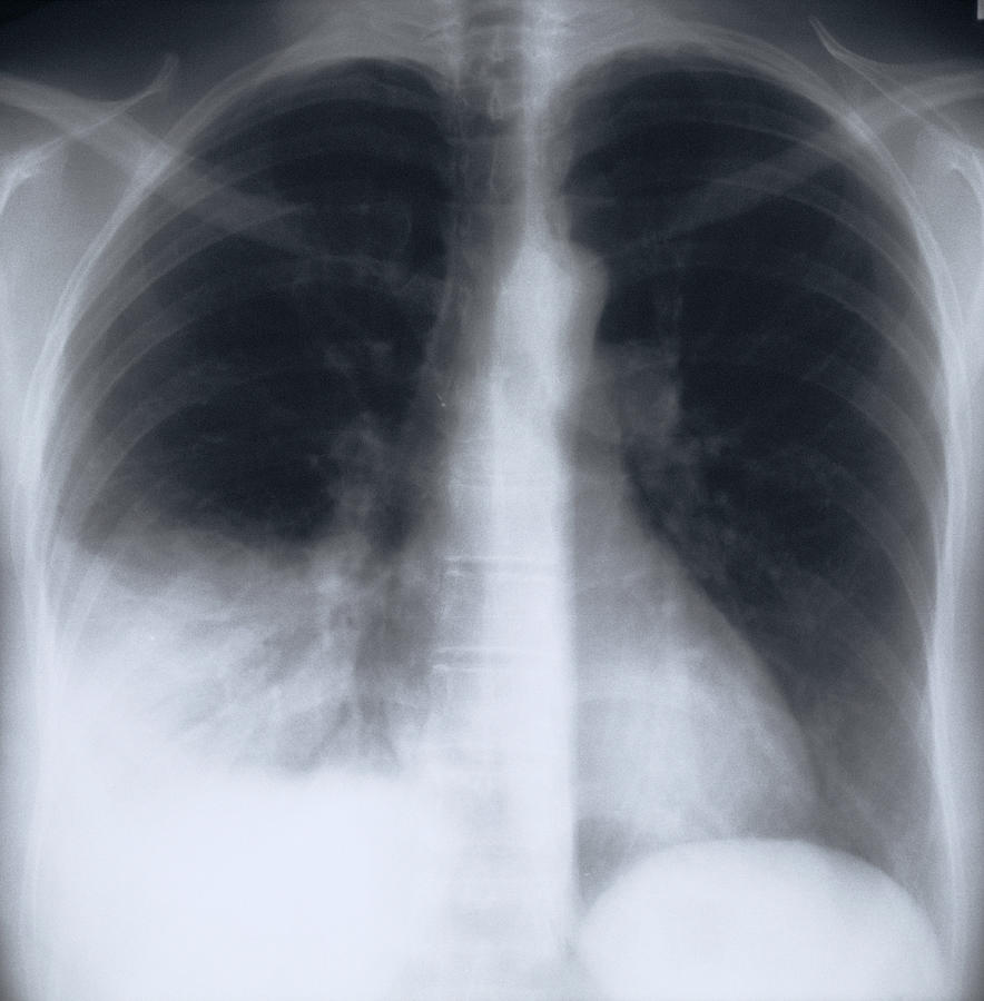 X-ray image of chest Photograph by Science Photo Library - CNRI/SPL