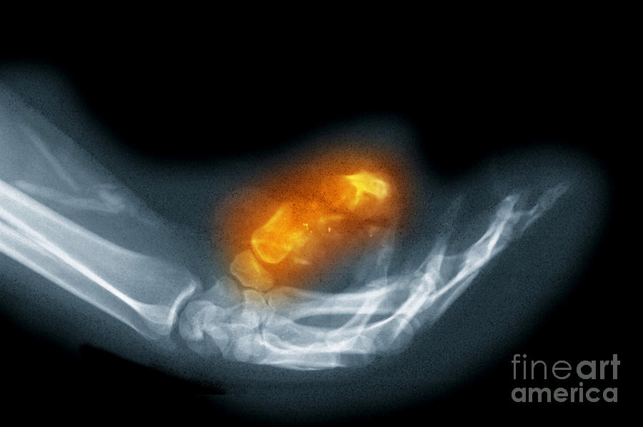 x-ray-of-a-gunshot-wound-to-the-hand-photograph-by-scott-camazine