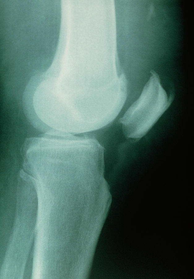 Patellar Tendon Rupture Repair