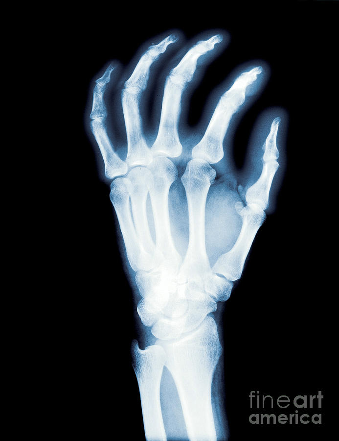 X-ray Photograph - X-ray Of A Normal Human Hand by Erich Schrempp