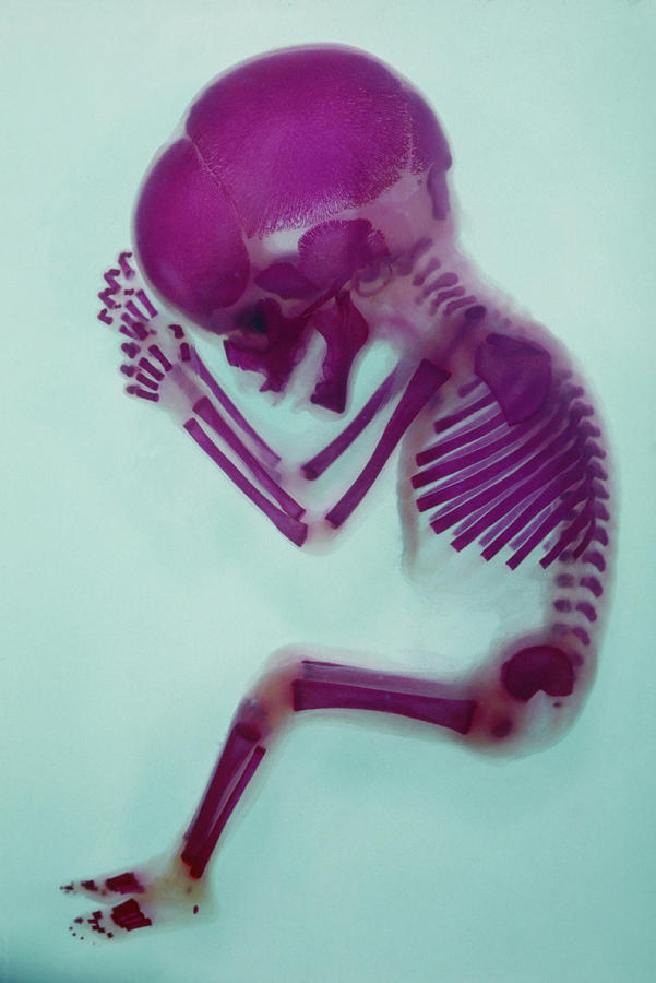 X-ray Of Aborted Foetus Photograph by Science Photo Library.
