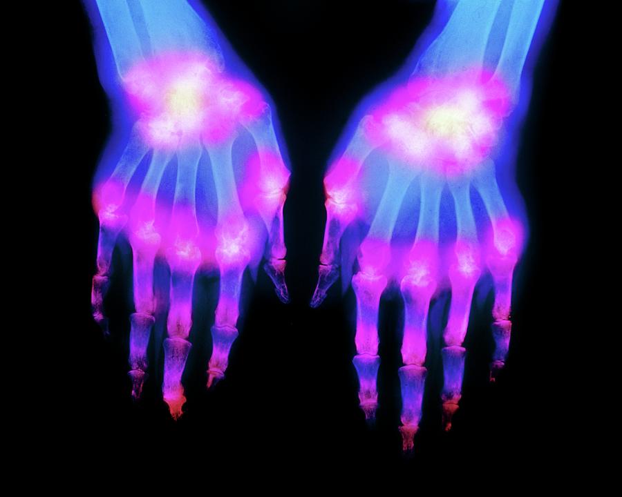 X-ray Of Arthritic Hand Photograph by Science Photo Library - Pixels