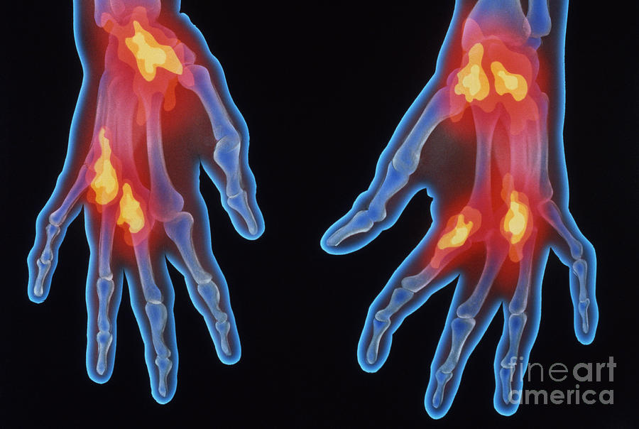 X-ray Of Arthritic Hands Photograph by Chris Bjornberg