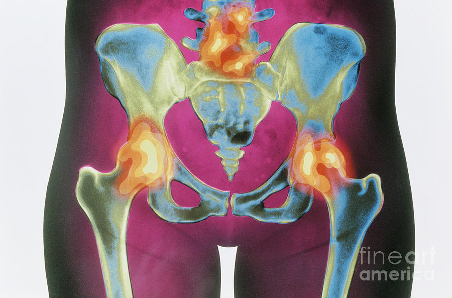 Arthritis Photograph - X-ray Of Arthritic Hips by Chris Bjornberg