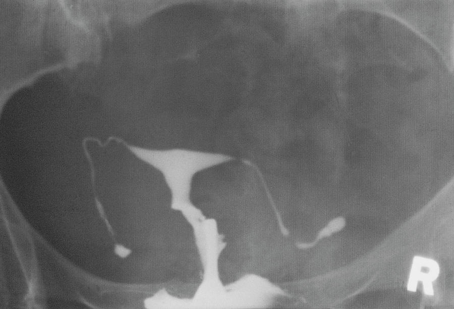 X-ray Of Blocked Falloppian Tubes Photograph by James Stevenson/science Photo Library